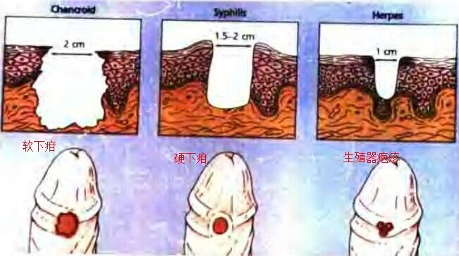 硬下疳与软下疳_软下疳_软下疳